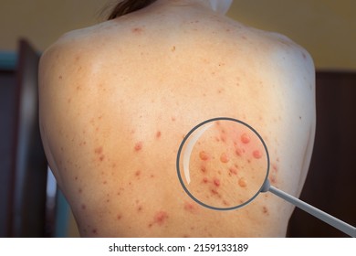 monkeypox infection virus on a woman's skin. Pandemic Monkeypox is a rare disease caused by a virus. Infection in Africa, Europe. - Shutterstock ID 2159133189
