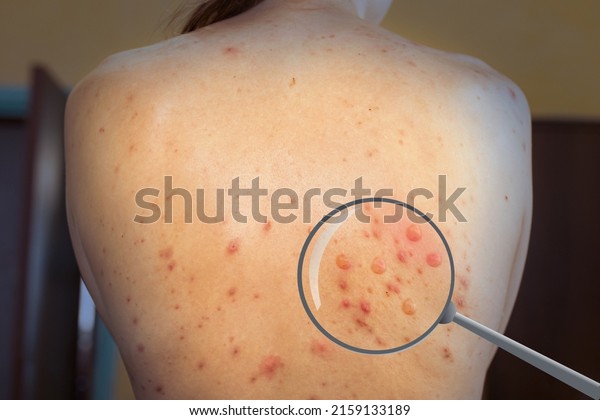 monkeypox infection virus on a woman\'s skin.\
Pandemic Monkeypox is a rare disease caused by a virus. Infection\
in Africa, Europe.