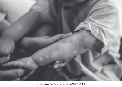 Monkeypox infection.African toddler child hand symptom monkeypox show doctor in laboratory lab confirm.Monkeypox is a rare disease infection virus.kid Health.infection in Africa Europe.hand virus.uk - Shutterstock ID 2162627613