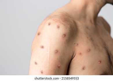Monkeypox new disease dangerous over the world. - Shutterstock ID 2158549553