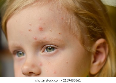 Monkeypox new disease dangerous over the world. Selective focus. Close-up of a Caucasian girl with pimples and ulcers on her face.