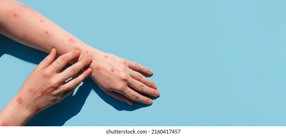 Monkeypox new disease dangerous over the world. Patient with Monkey Pox. Painful rash, red spots blisters on the hand. Close up rash, human hands with Health problem. Banner, copy space - Shutterstock ID 2160417457