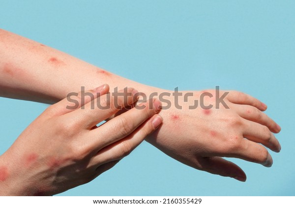 Monkeypox new disease\
dangerous over the world. Patient with Monkey Pox. Painful rash,\
red spots blisters on the hand. Close up rash, human hands with\
Health problem.