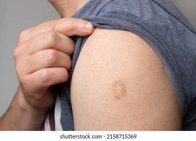Monkeypox and smallpox vaccine scar on young man's arm - Shutterstock ID 2158715369