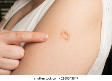 Monkeypox and smallpox vaccine scar on a woman's left arm - Shutterstock ID 2160343847