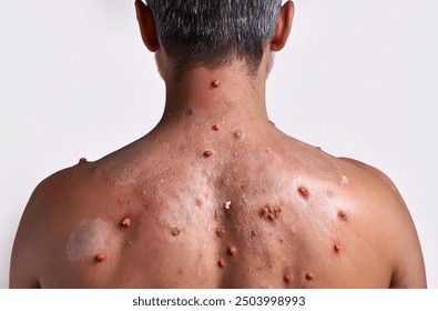 Monkeypox Virus on the skin, Microscopic View of the Monkeypox Virus. Close-Up Image of the Monkeypox Virus Structure, Skin Manifestation of Monkeypox, Dermatological viruses  - Powered by Shutterstock