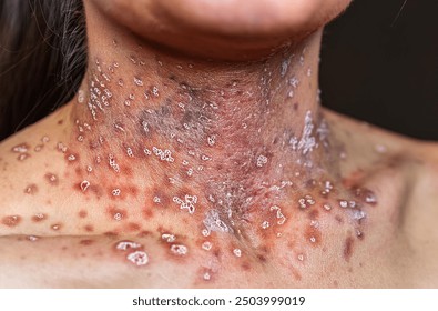 Monkeypox Virus on the skin, Microscopic View of the Monkeypox Virus. Close-Up Image of the Monkeypox Virus Structure, Skin Manifestation of Monkeypox, Dermatological viruses  - Powered by Shutterstock