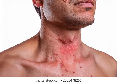 Monkeypox Virus on the skin, Microscopic View of the Monkeypox Virus. Close-Up Image of the Monkeypox Virus Structure, Skin Manifestation of Monkeypox, Dermatological viruses  - Powered by Shutterstock