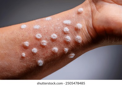 Monkeypox Virus on the skin, Microscopic View of the Monkeypox Virus. Close-Up Image of the Monkeypox Virus Structure, Skin Manifestation of Monkeypox, Dermatological viruses  - Powered by Shutterstock