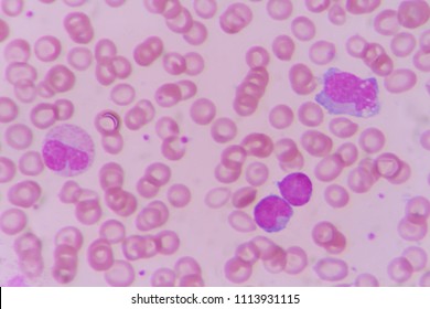 Monocyte Lymphocyte Blood Smear Under Microscopy Stock Photo 1113931115 ...