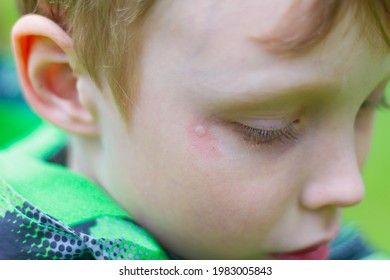 Mosquito Bite Mark On Baby Boy's Face.