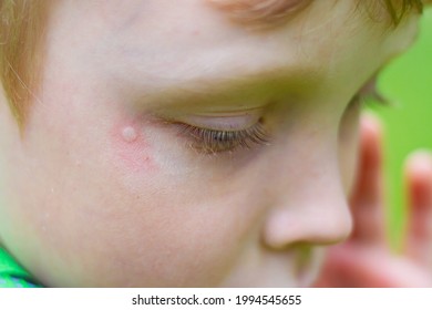 Mosquito Bite Mark On Baby Boy's Face.