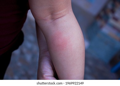 A mosquito bite on the calf of a girl is a red swollen mark.