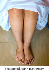 Mosquito Bite Scars On Both Legs On Kid