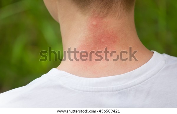 mosquito bites. Girl with blond hair, sitting with\
his back to turn. Close-up of visible red, swollen neck skin from\
mosquito bites in the summer in the woods. Insect bites. Irritated\
skin.