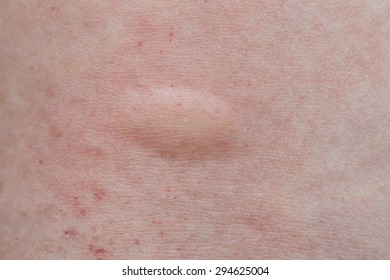 mosquito bites woman leg