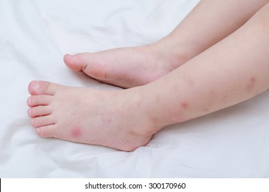 Mosquito bites sore baby legs