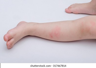 Mosquito bites sore baby legs