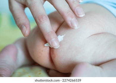 The mother applies a healing cream to the baby's red bottom. Healing ointment for diaper rash, irritation and redness on the delicate skin of a baby.
