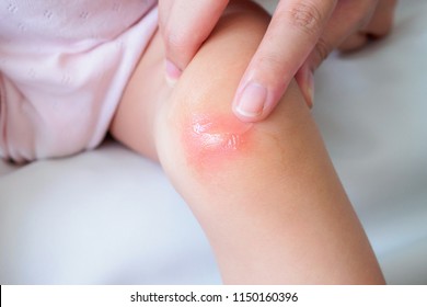 Babies allergic reaction to mosquito bites