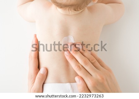 Mother hand applying white medical ointment on infant bare back. Red rash on skin. Allergy from milk formula or mother milk. Care about baby body. Closeup. Top down view.