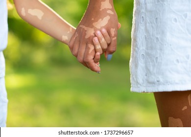 Mother Leads Her Kid In Summer Forest Nature Outdoor. Female And Child's Hands With Vitiligo Skin Closeup. Parent Walks With Daughter With White Pigmentation In Park. Diversity Tolerance Concept. 