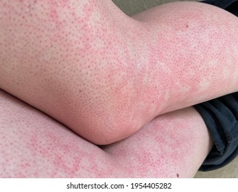 mottled skin heat rash hives allergy reaction on knee close-up reference picture of blotchy mottled red skin erythema ab igne also known as EAI this can also happen at end of life death situations 