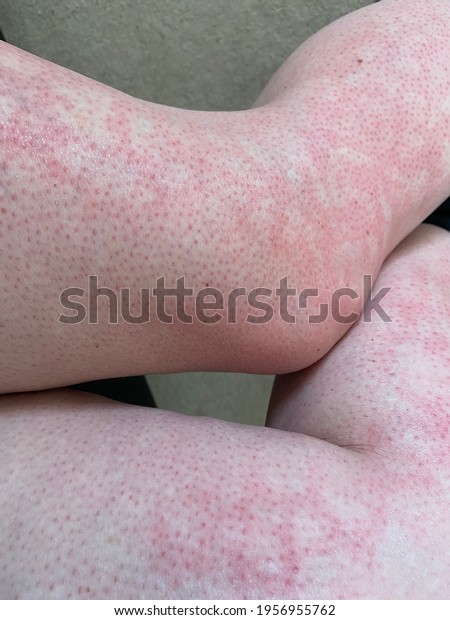 mottled skin heat rash hives allergy reaction on knee\
close-up reference picture of blotchy mottled red skin erythema ab\
igne also known as EAI this can also happen at end of life death \
\
situations 