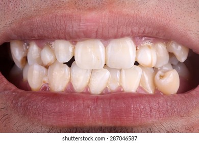 Mouth With Crooked Teeth