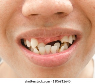 Overlapping Jaws High Res Stock Images Shutterstock