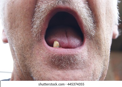The Mouth of the person with sick teeth.Open mouth without teeth