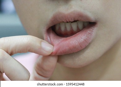 mouth ulcer, canker sore, aphthous stomatitis  - Shutterstock ID 1595412448