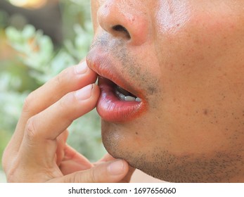 Mouth Ulcer, The Expression Of A Young Asian Man With Style As If He Is Taste Were Spicy. Spicy Concept