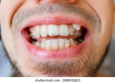 Mouth Of A Young Man. See Teeth That Are Not Aligned.teeth With Invisble Braces.