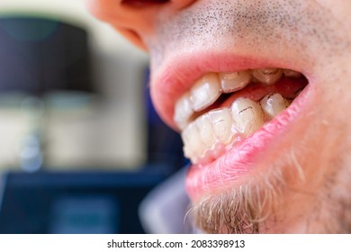 Mouth Of A Young Man. See Teeth That Are Not Aligned.teeth With Invisble Braces.