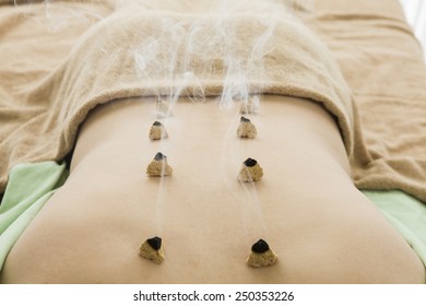 Moxibustion 