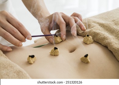 Moxibustion