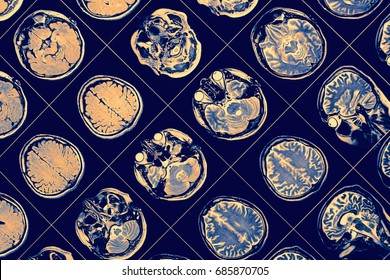 MR image of human brain