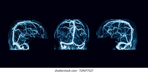 MRA of brain, case of intracerebral hemorrhage (ICH)