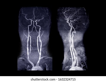MRA Brain and neck or Magnetic resonance angiography ( MRA )  of cerebral artery and common carotid artery AP and Lateral View  for evaluate them  stenosis  and stroke disease.