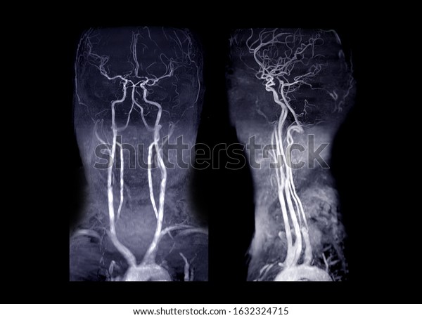 MRA Brain\
and neck or Magnetic resonance angiography ( MRA )  of cerebral\
artery and common carotid artery AP and Lateral View  for evaluate\
them  stenosis  and stroke\
disease.