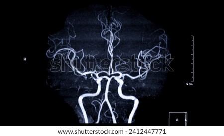 MRA Brain , This imaging technique provides clear visuals of the brain's arterial and venous structures, aiding in the diagnosis of vascular conditions and neurological issues.