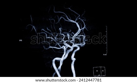 MRA Brain , This imaging technique provides clear visuals of the brain's arterial and venous structures, aiding in the diagnosis of vascular conditions and neurological issues.