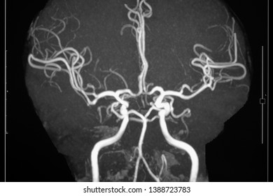 Circle Of Willis Anatomy Brain Mri