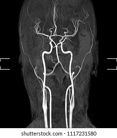 87 Basilar artery Images, Stock Photos & Vectors | Shutterstock