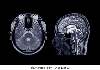 MRI Brain Axial And Sagittal Plane For Detect Stroke Disease.