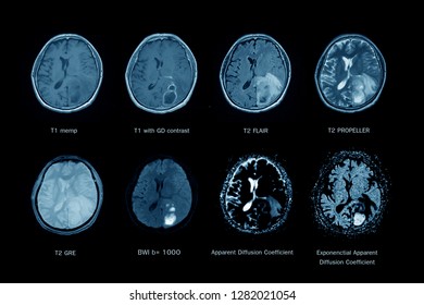 MRI of the brain, Axial view, Technique and Sequences: T1 memp, T2 FRAIR, T2 GRE, T1 with contrast, T2 PROPELLER,BWI, Apparent Diffusion Coefficient, and Exponenctial Apparent Difffusion Coefficient ,