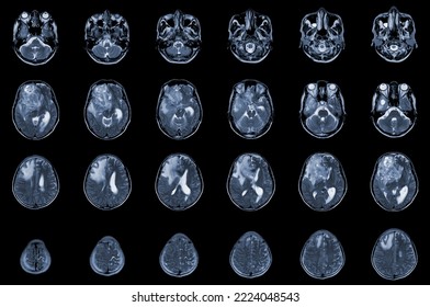 MRI Brain Axial views .to evaluate brain tumor. Glioblastoma, brain metastasis isodensity mass with an ill-defined margin and surrounding edema at the right frontal lobe.Medical image concept.