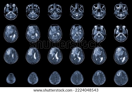 MRI Brain Axial views .to evaluate brain tumor. Glioblastoma, brain metastasis isodensity mass with an ill-defined margin and surrounding edema at the right frontal lobe.Medical image concept.