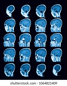 MRI Of The Brain Case Of Pituitary Mass, Sagittal View